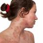 Podstawy pielęgnacji skóry u pacjentów z atopowym zapaleniem skóry